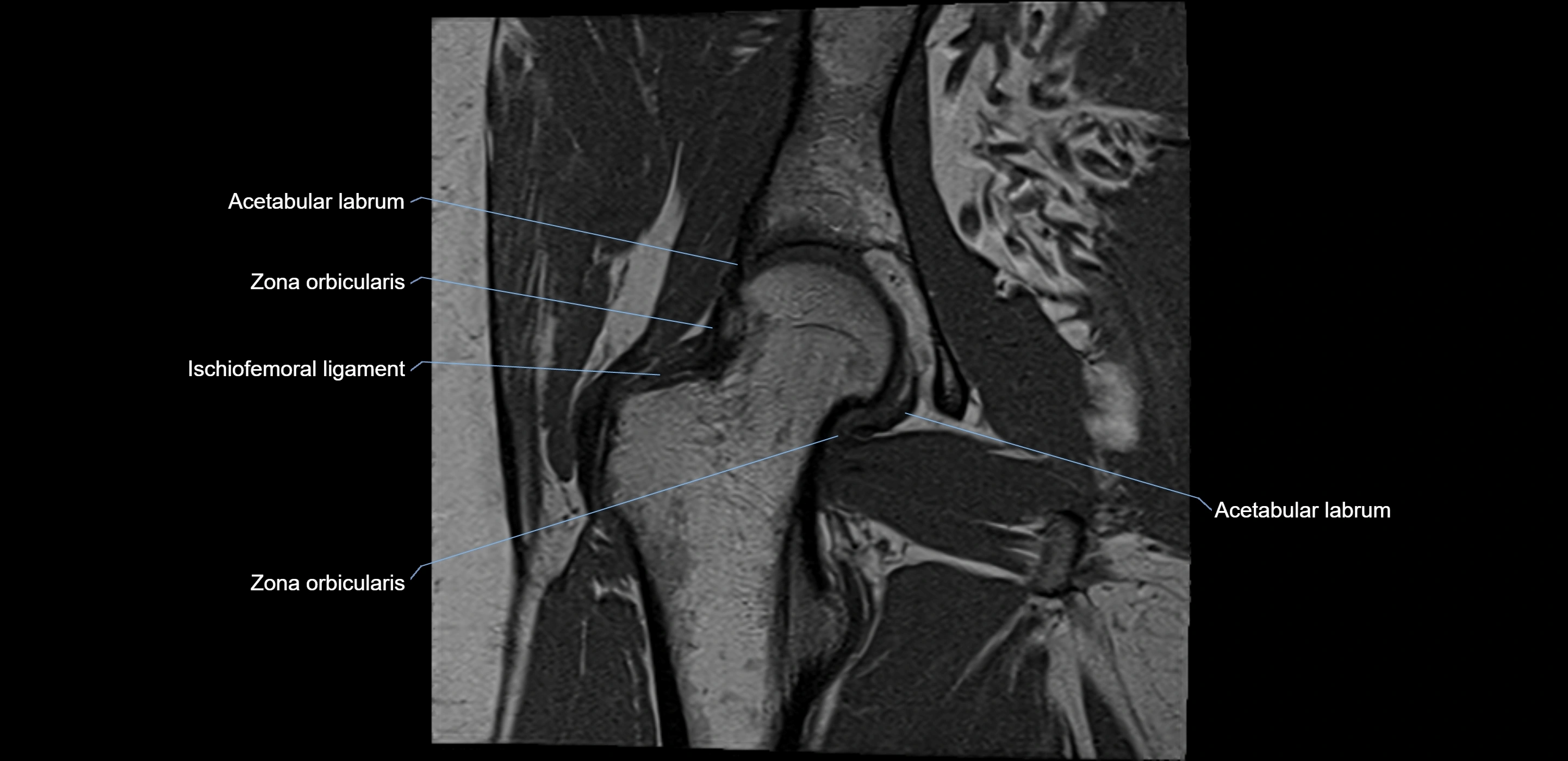 MRI Hip ligaments coronal cross sectional anatomy 3T  radiology  image-img-00001-00015.webp